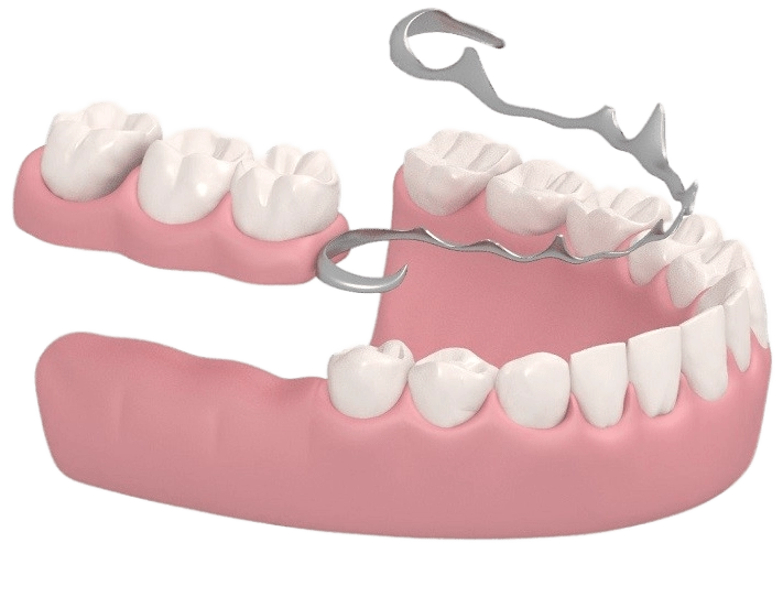 Баннер Бюгельный зубной протез на нижнюю челюсть