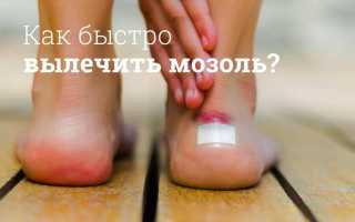 Мозоли и натоптыши