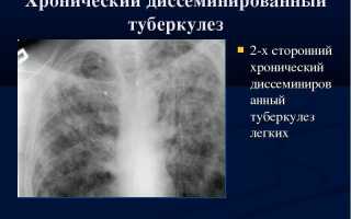 Закон о прививках против туберкулеза