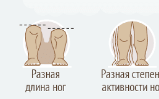 Врожденный вывих бедра