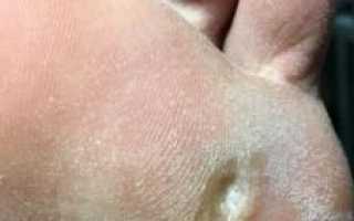 Мозоли на стопах и пятках причины, способы диагностики и лечения