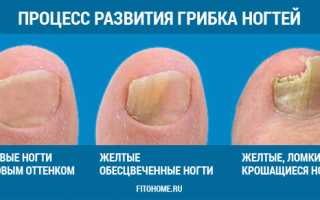 Грибок ногтей чай паразитарный
