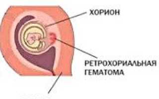 Гематома