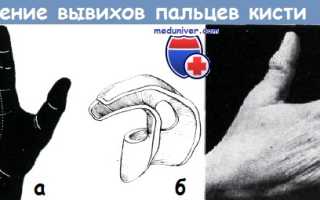 Вывих пальца