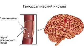Геморрагический инсульт