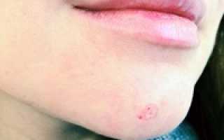 Уход за кожей после удаления родинки лазером