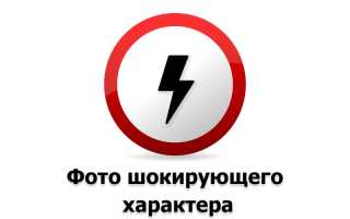 Кандидоз крупных складок дрожжевая опрелость