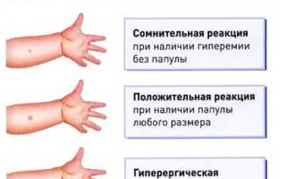 Инфильтративный туберкулез проба манту