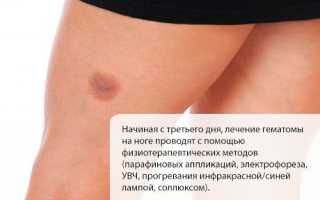 Лечение ушиба ноги в домашних условиях