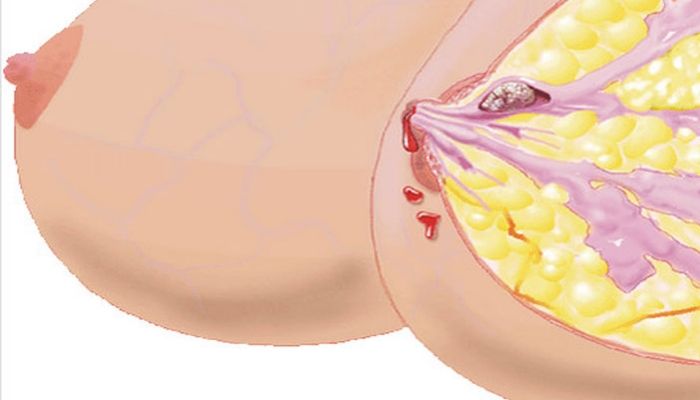 Папиллома внутренняя