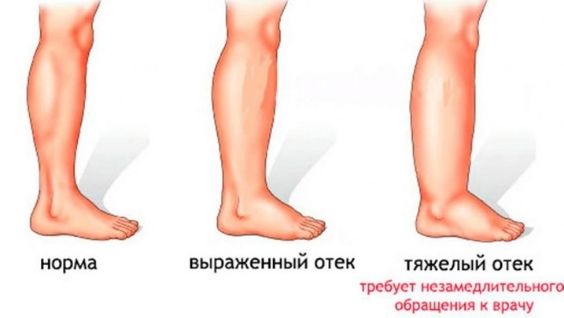 отеки у беременных