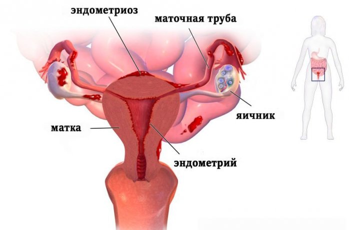 Эндометриоз