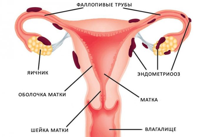 Эндометриоз