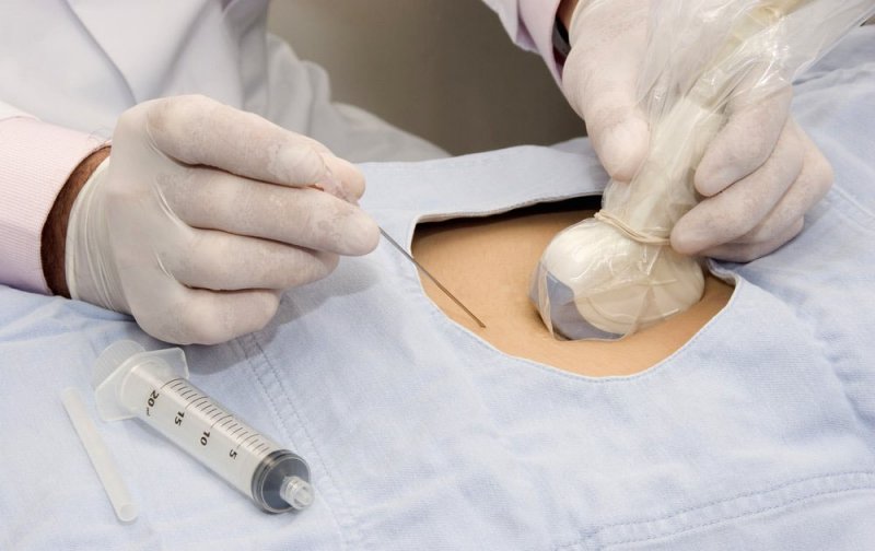 Процедура амниоцентез