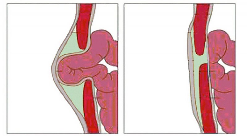 Выпячивание