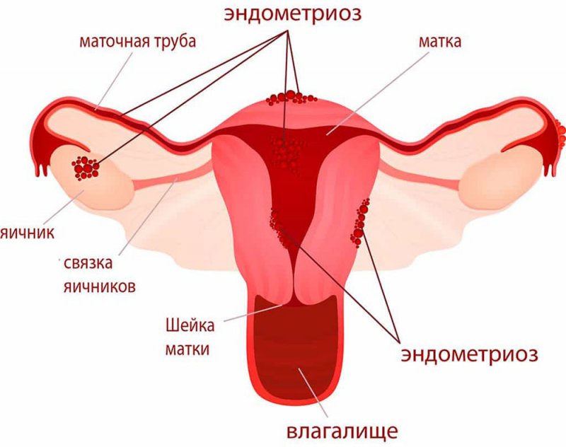 Эндометриоз