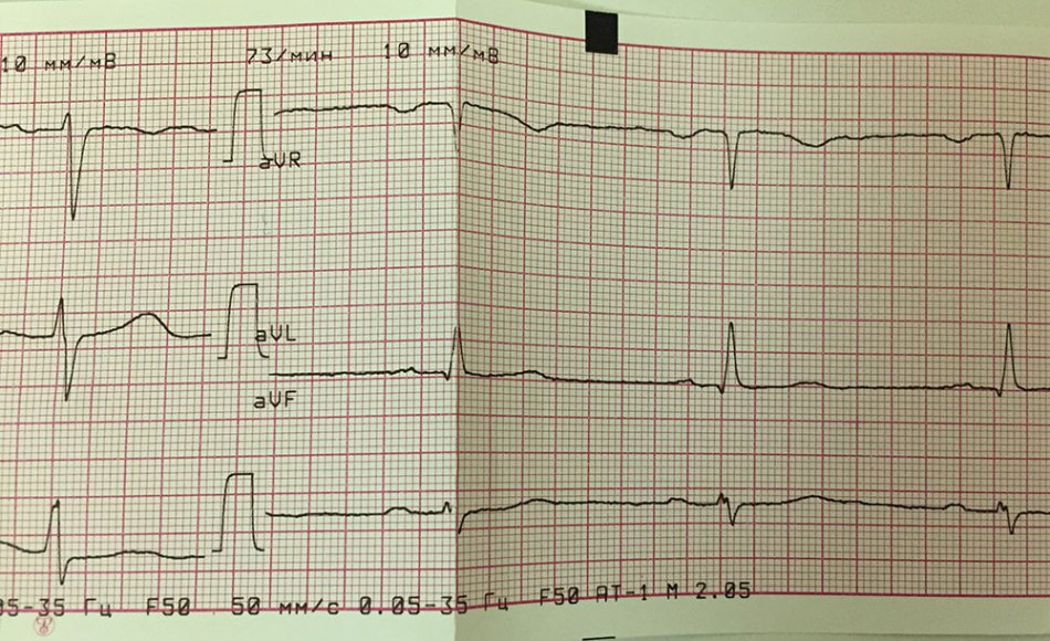 ЭКГ беременной женщины