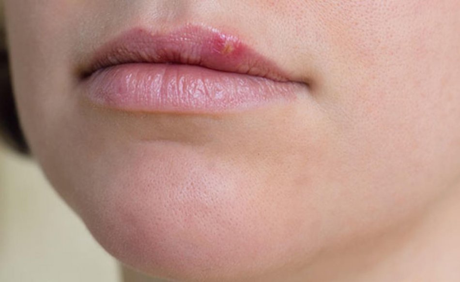 Герпес на лице