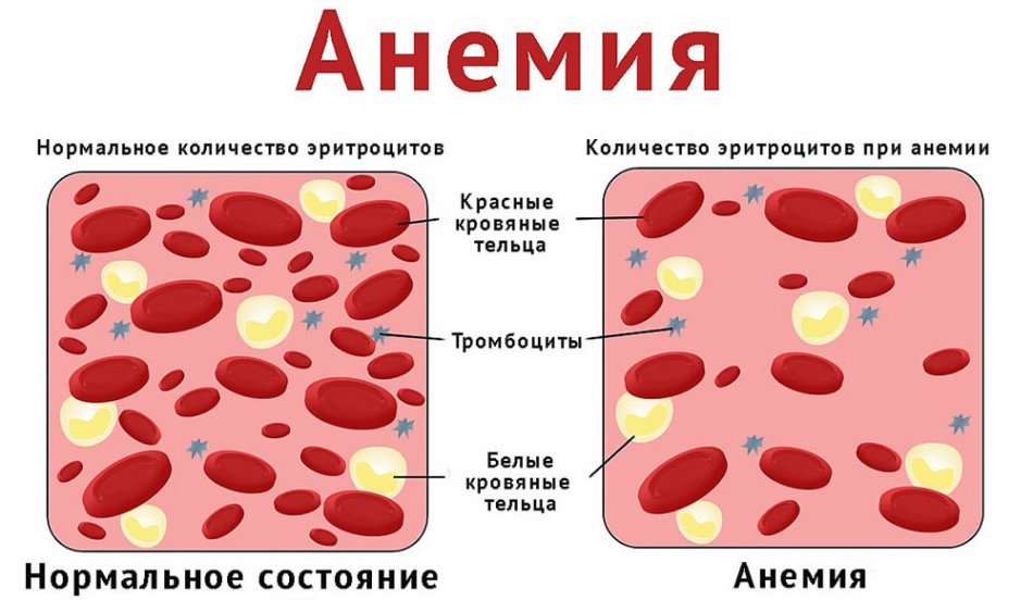 Признаки анемии у беременных