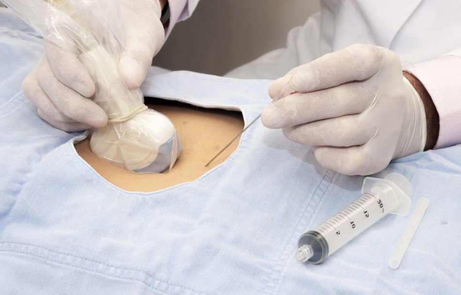 Проведение амниоцентеза