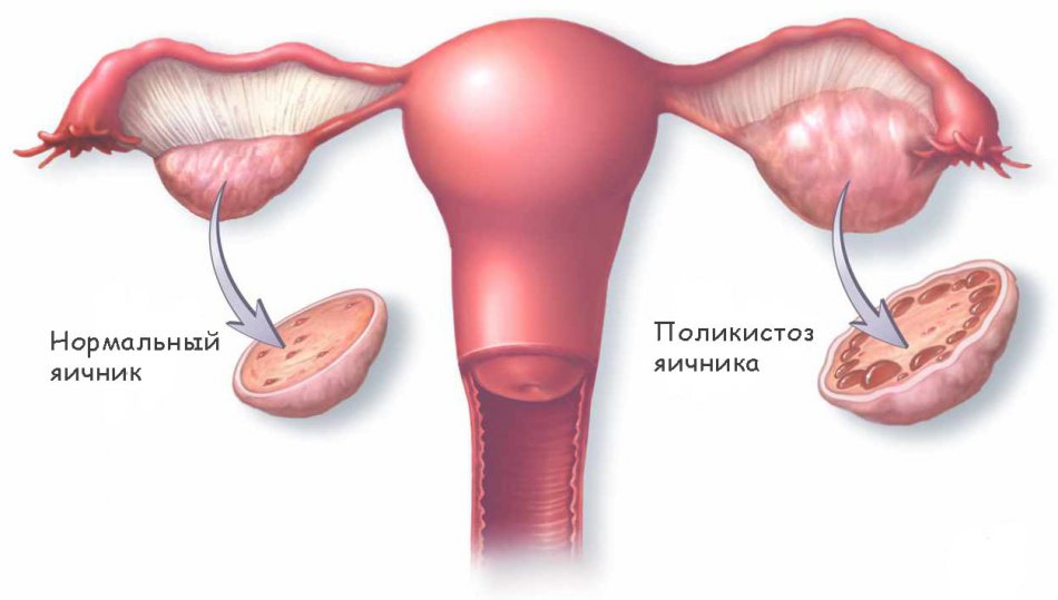 Синдром поликистозных яичников