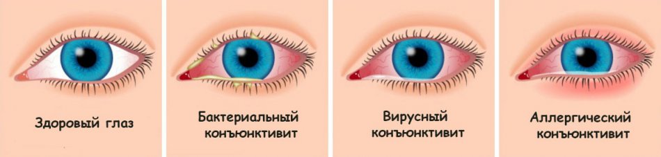 Виды конъюнктивитов