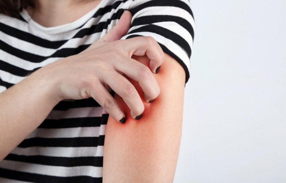 Крапивница