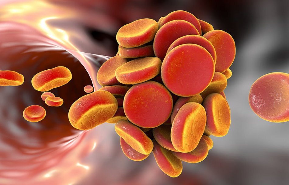 Образование тромба