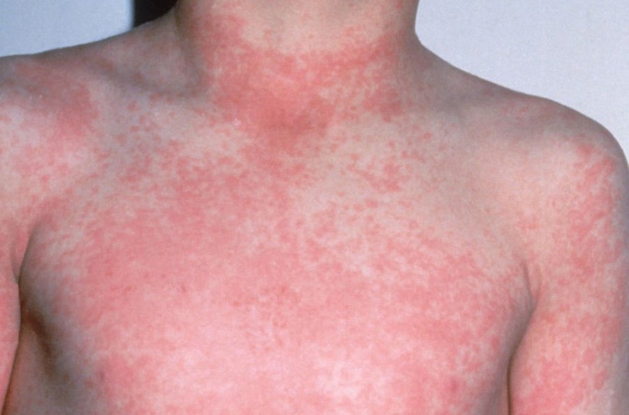 Высыпания на коже