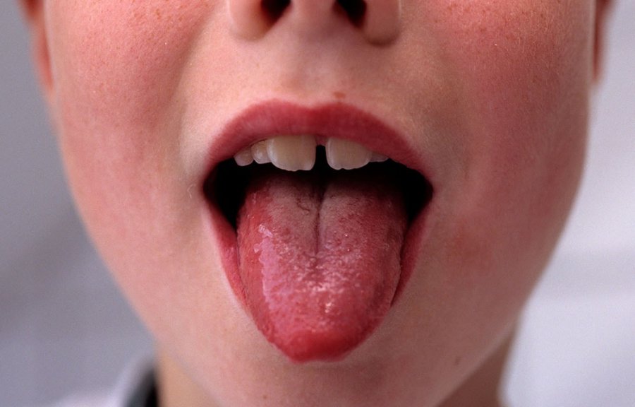 Язык при скарлатине