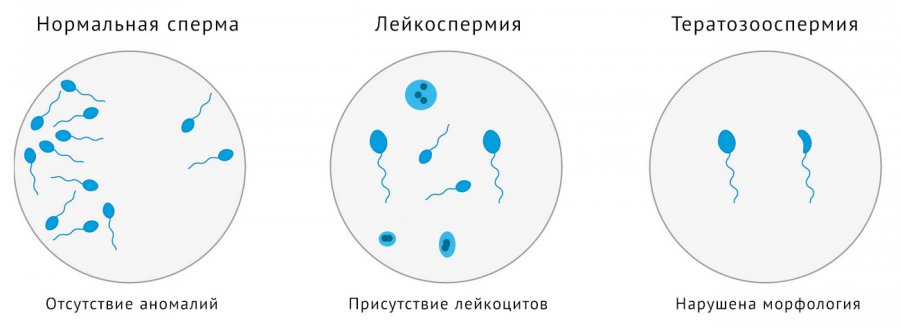 Лейкоспермия