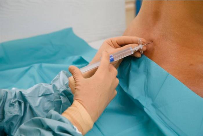 восстановление после кесарево