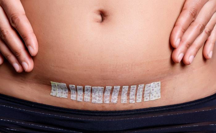 восстановление после кесарева