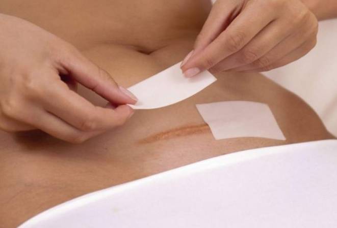 восстановление после кесарева сечения со спинальной анестезией