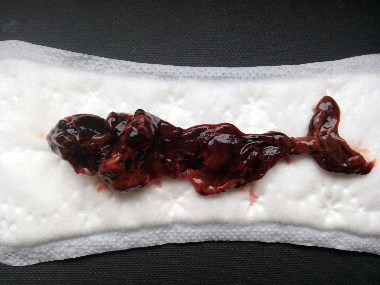 Большие сгустки