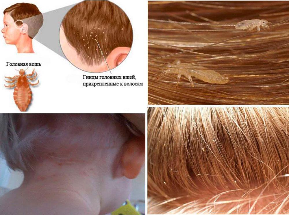 Вши на голове