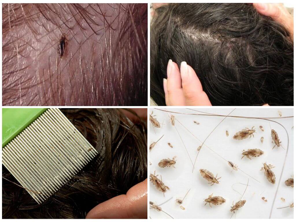 Как выглядят вши и гниды