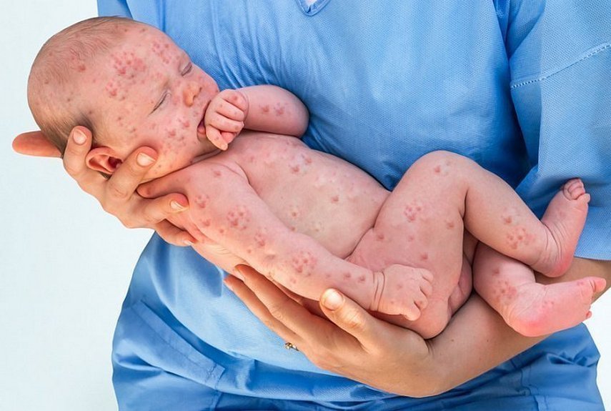 Детская краснуха