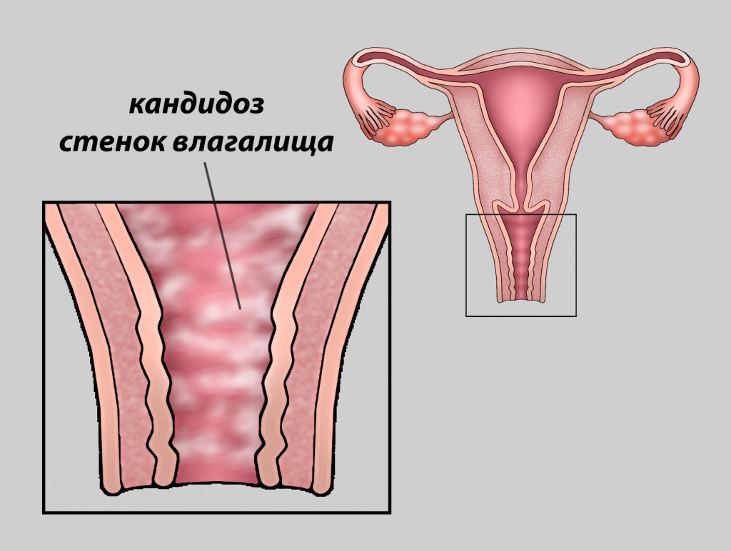 Молочница