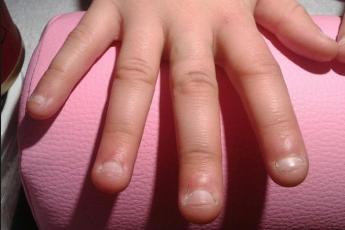 Обгрызанные ногти у ребенка