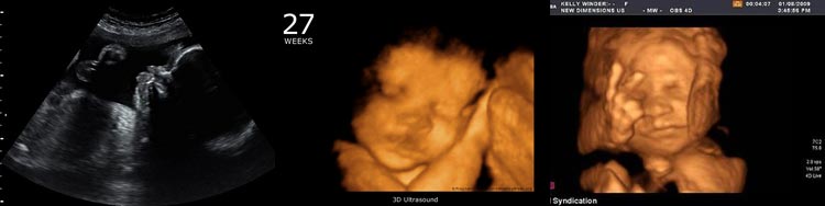 Плод на 27 неделе