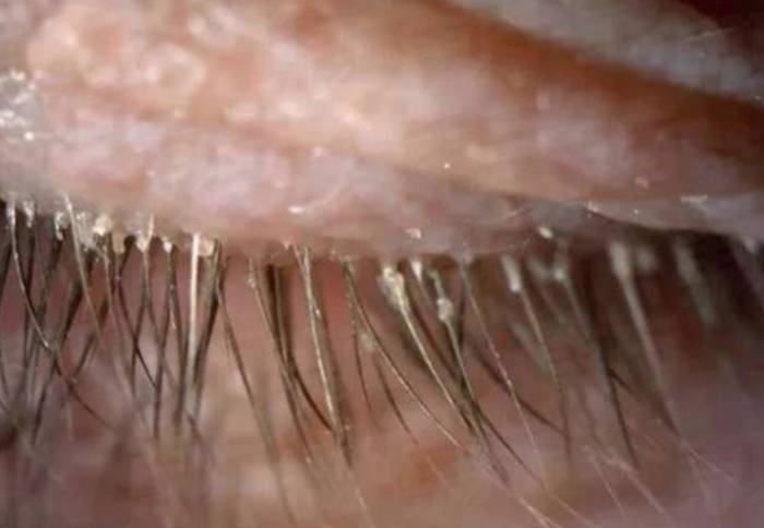 Ресничные вши