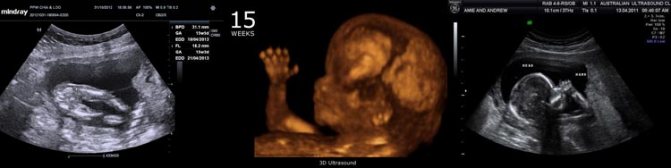 УЗИ на 15 неделе