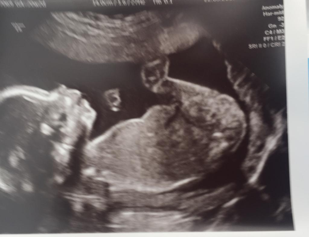 УЗИ 20 недель