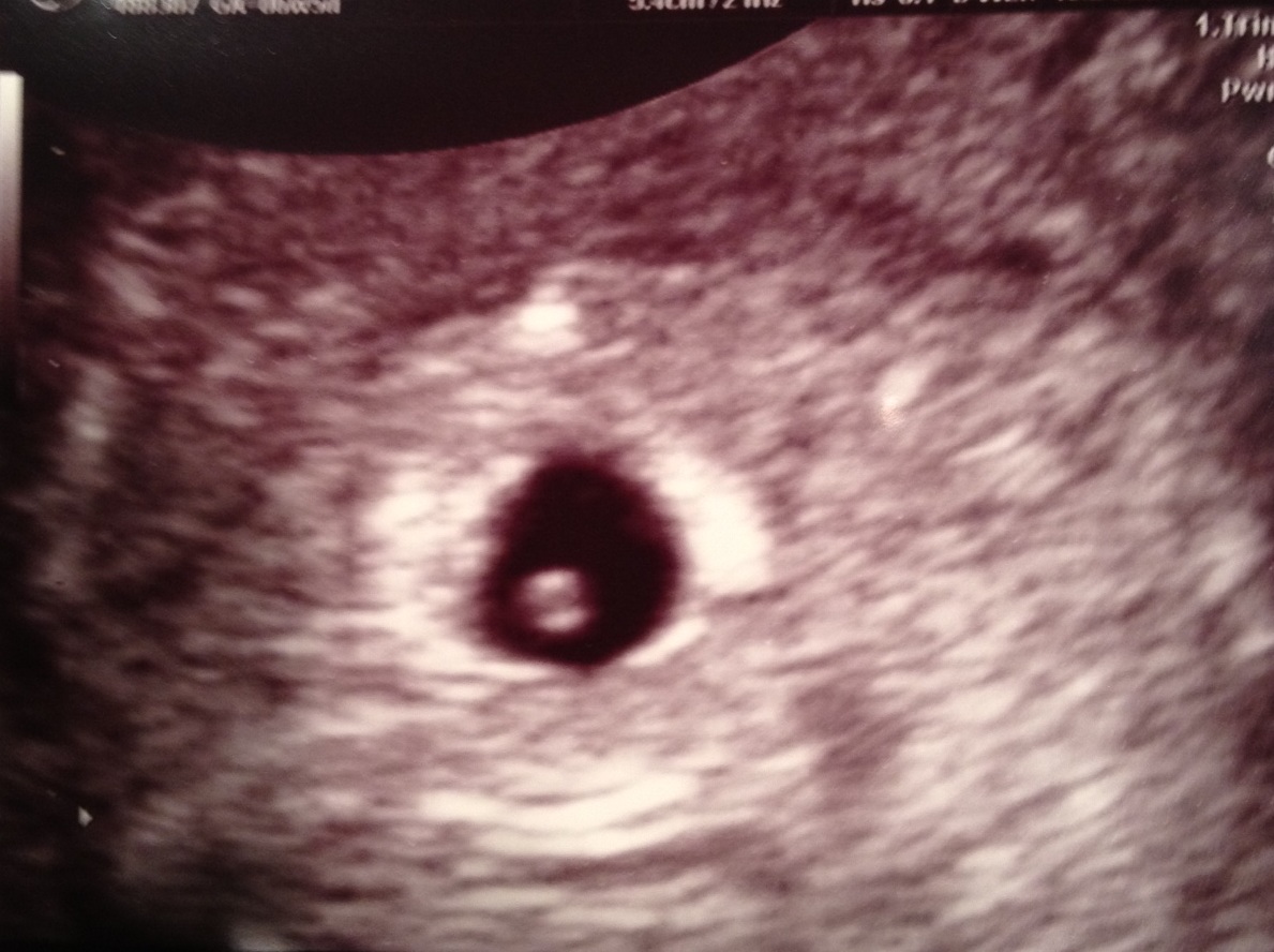 УЗИ 5 недель беременности