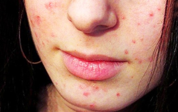Угревая сыпь