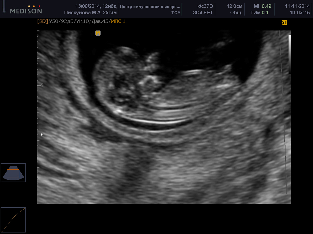 Узи плода 1 триместр