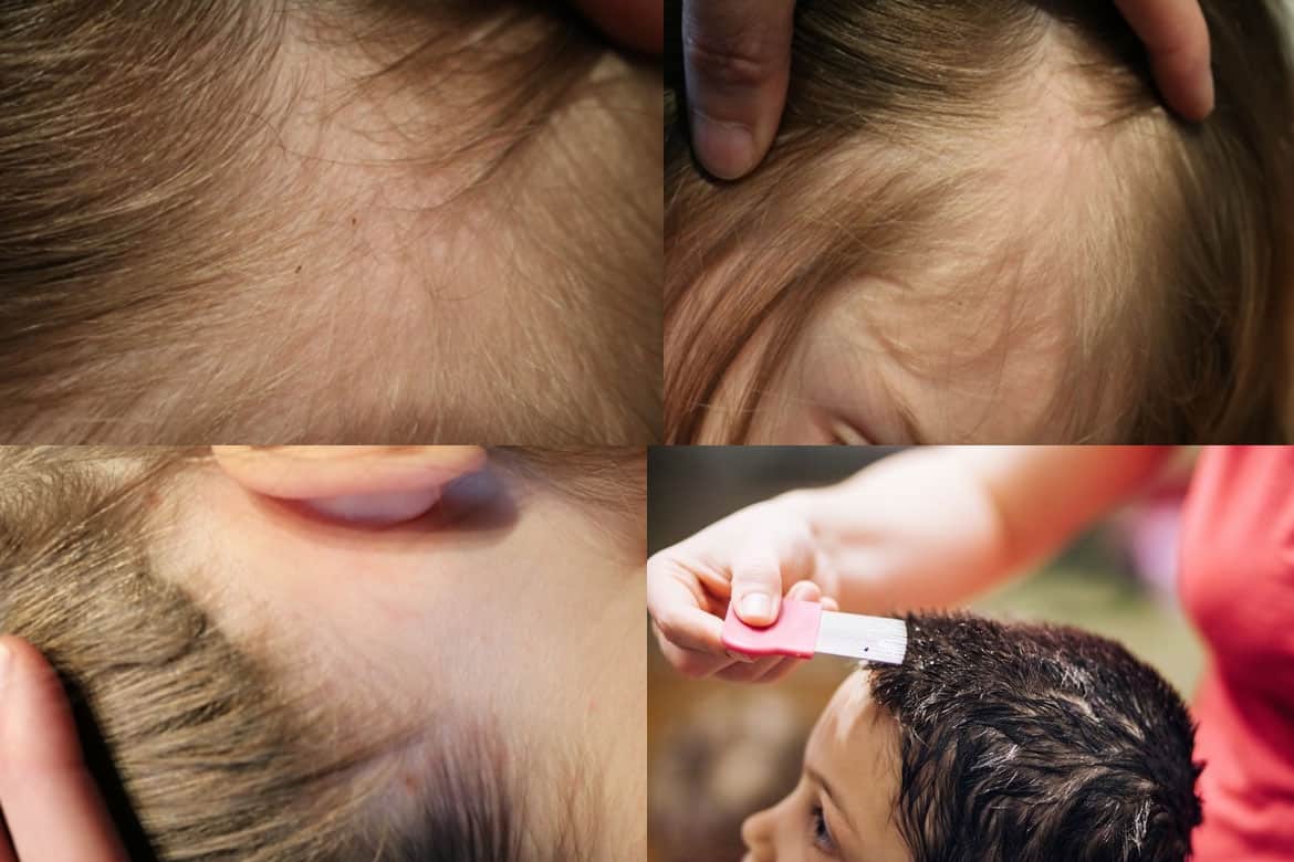 Зуд головы от вшей