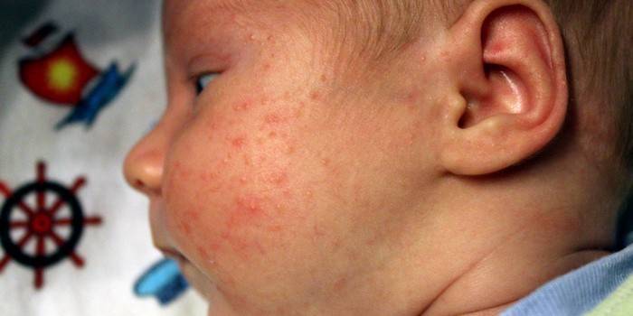 Краснуха у грудничка