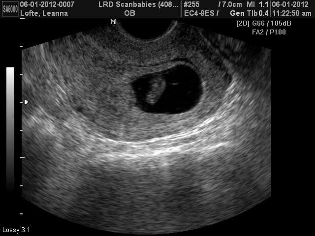 узи на 7 недель